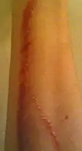 An abrasion