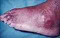Tophus of the toe, and over the external malleolus