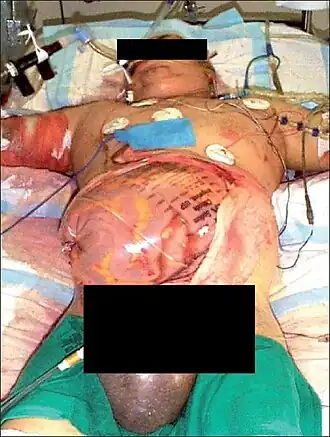 Decompression laparotomy for abdominal compartment syndrome in a burn patient
