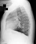 asbestosis, a disease caused by asbestos
