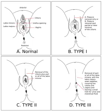 Diagram showing types of female genital mutilation