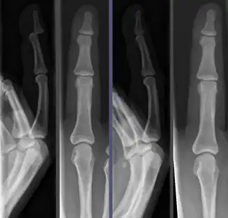 A dislocated finger bone before and after reduction
