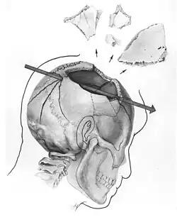 Sketch of the fatal bullet wound for president Kennedy
