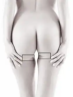 Horizontal gluteal crease