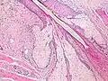 Joining of sebaceous glands into hair shaft