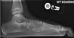 Lateral X-ray of a flat foot with C-sign, which is a bony bridge between the talar dome and sustentaculum tali, in combination with a prominent inferior border of the sustentaculum tali. This represents a talocalcaneal coalition, which is an abnormal connection between the talus and calcaneus, and is thought to cause the flat foot deformity in this case.