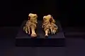 Feet deformed by leprosy