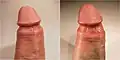 Before and after treatment for pearly penile papules