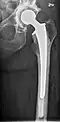 Hip prosthesis - anteroposterior (AP) view