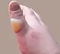 Second degree burn of the thumb
