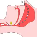 An obstruction makes breathing difficult