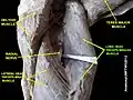 Long head triceps brachii muscle (shown in green text)