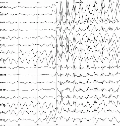 The electroencephalogram recording of a person with childhood absence epilepsy showing a seizure. The waves are black on a white background.