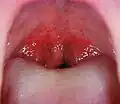 A case of strep throat. Note the  small red spots. This rash is an uncommon but a specific sign.