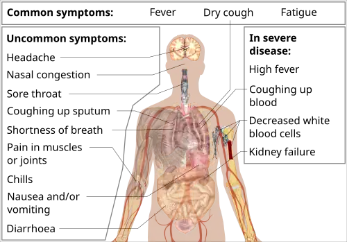 COVID-19 symptoms