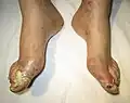 Gout complicated by ruptured tophi (exudate tested positive for uric acid crystals)