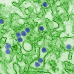 Electron micrograph of "Zika virus". Virus particles (colored purple) are 40&nbsp;nm in diameter, with an outer envelope and a dense inner core.